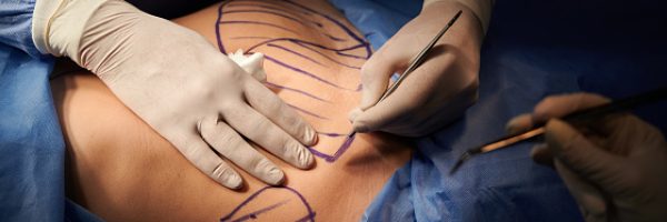 Close up of plastic surgeon hands in sterile gloves using scalpel while doing plastic surgery in clinic. Concept of cosmetic surgery and abdominoplasty.