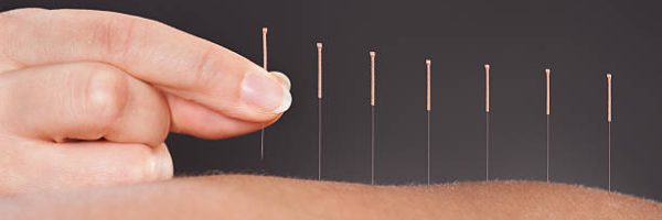 Close-up Of A Person Getting An Acupuncture Treatment At Spa